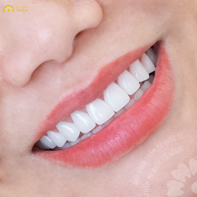 Bác sĩ sẽ gắn răng sứ lên cùi răng và cố định bằng keo dán nha khoa chuyên dụng
