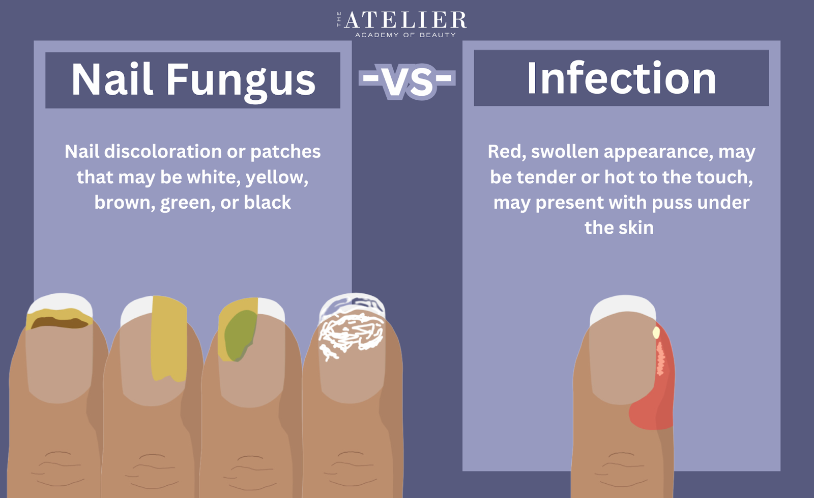 Diagram of illustrated examples of Nail Fungus Vs Infection.  Nail Fungus- Nail discoloration or patches that may be white, yellow, brown, green, or black.  Infection- Red, swollen appearance, may be tender or hot to the touch, may present with puss under the skin