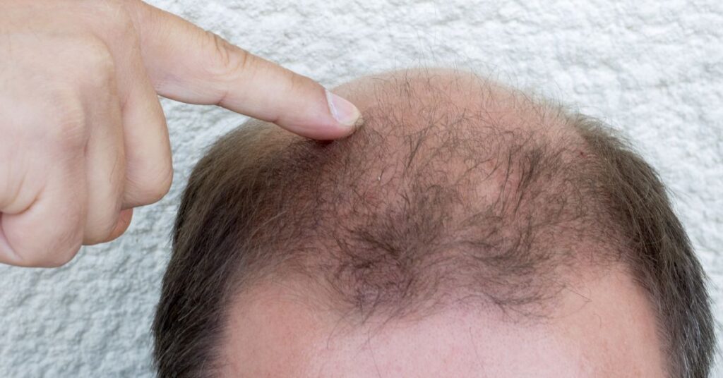 Hair Loss and Exploring Modern Treatments