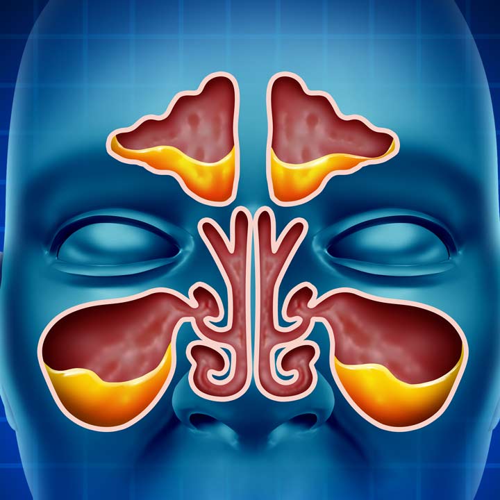 التهاب الجيوب الانفية (Sinusitis)