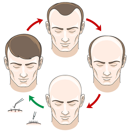 Infographic of hair transplantation