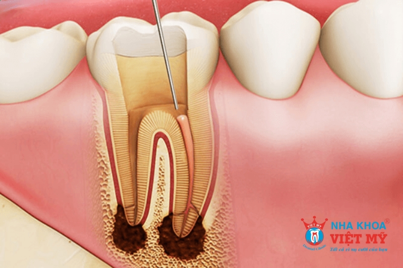 công nghệ giúp lấy tủy răng không đau