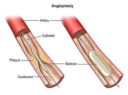 When is Angioplasty Recommended?