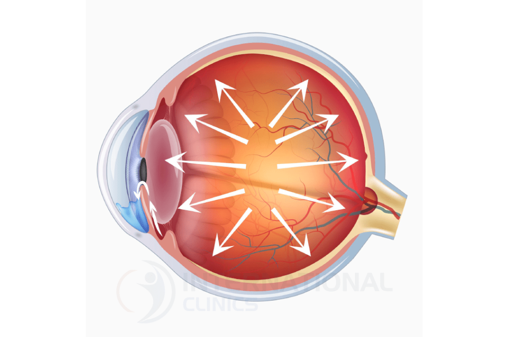 what is intra ocular pressure