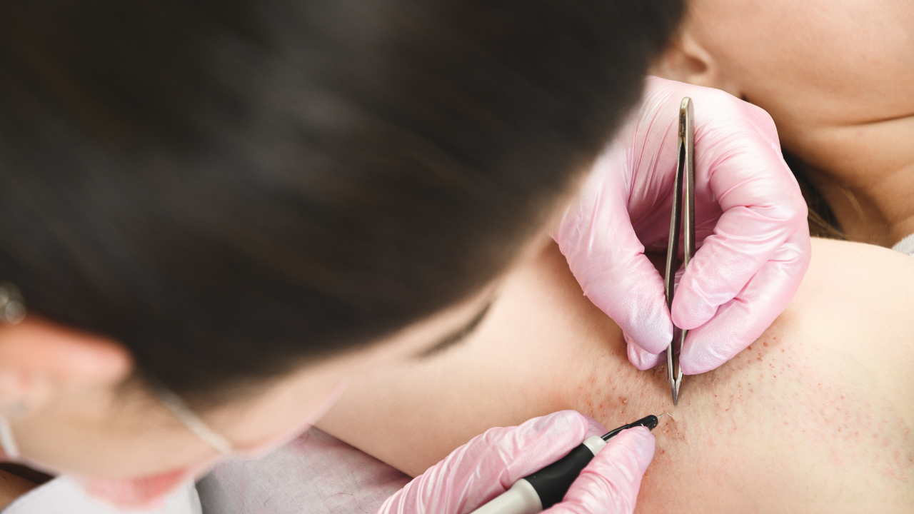 A picture of an Electrologists doing electrolysis on a client at the under arm area