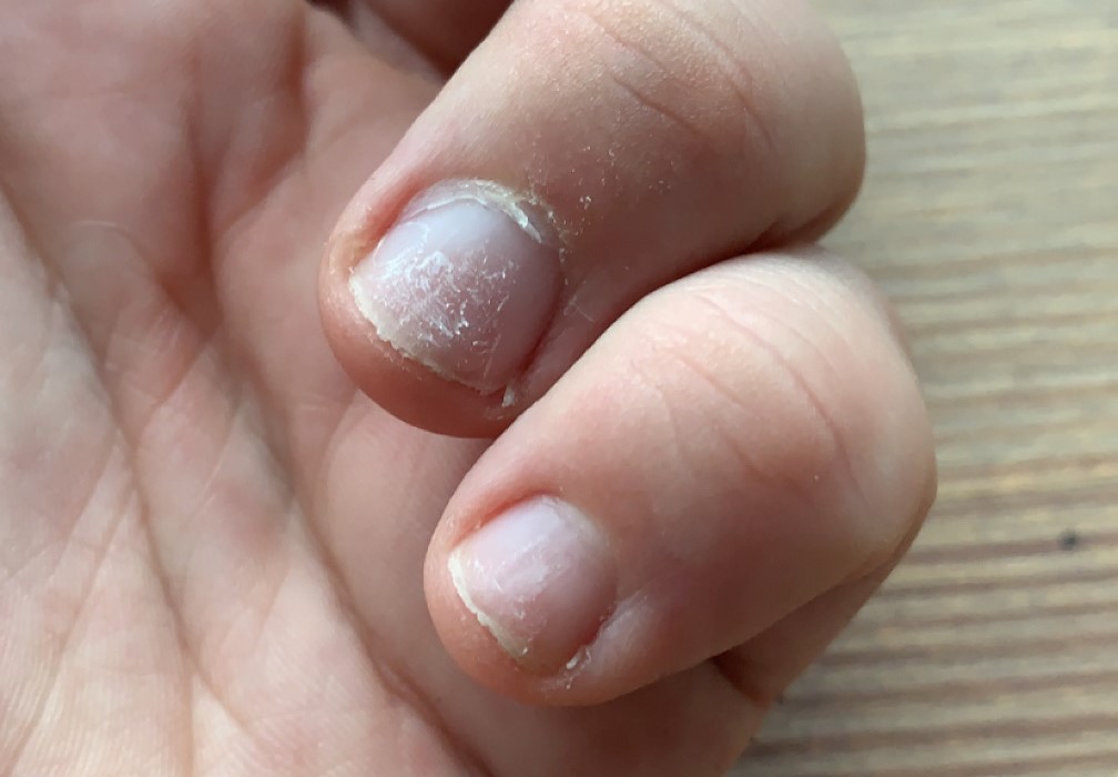 Two fingernails display signs of delamination, including a damaged top layer of the nails and a rough surface.