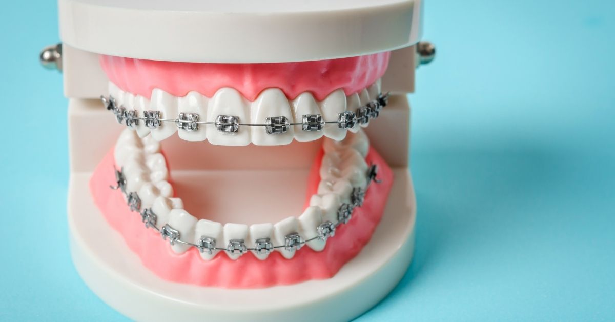 Understanding Braces.jpg