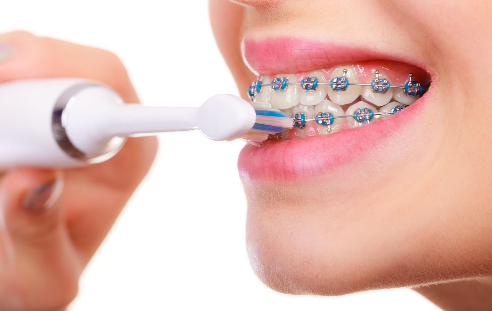 A person with blue braces uses an electric tooth brush to gently clean their braces after a meal.