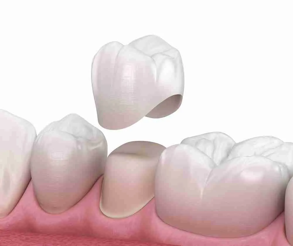 Bọc răng sứ thẩm mỹ: Giải pháp phục hình hiện đại mang lại nụ cười hoàn hảo