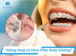 Niềng Răng Có Tiêm Filler Được Không  Tất Tần Tật Những Điều Bạn Cần Biết