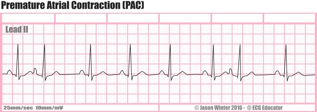 The ECG Educator & Mentor Blog : Premature Atrial Contraction (PAC)