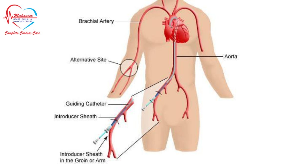 Peripheral Angiography - Dr Rakesh Jain a Best Cardiologist