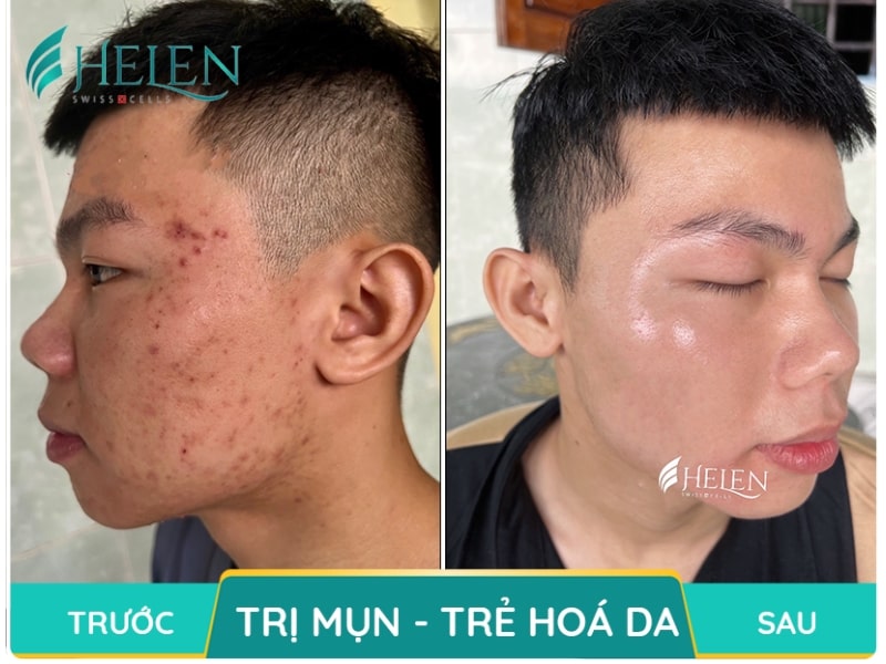 Hiệu quả trước và sau trị mụn tại Helen Swiss Cells