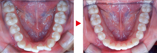症例02矯正写真（下）、治療前→治療後