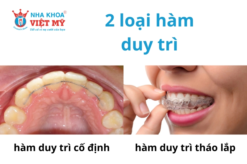 hàm duy trì tháo lắp và cố định cho niềng răng