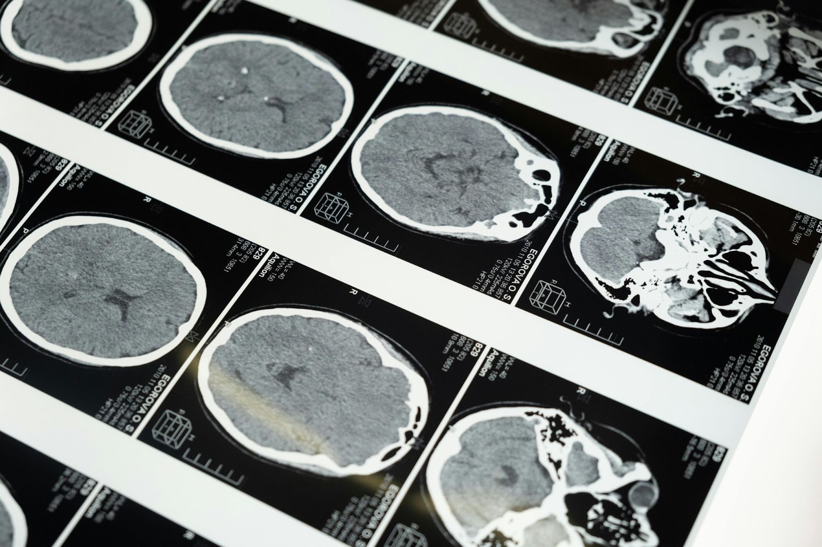 Black and white images of brain scans.