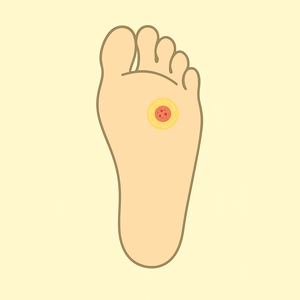 comment soigner cor pied