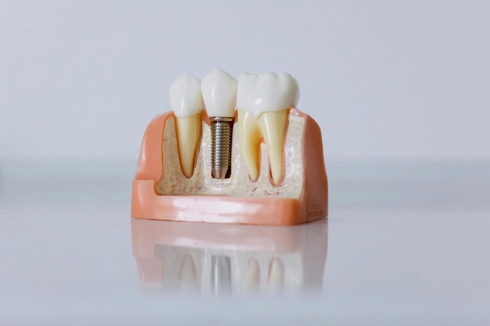 dental-implant-display-model