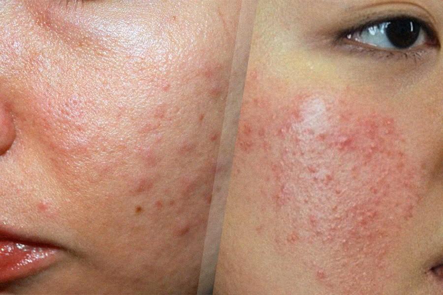 Sử dụng kem chống nắng tốt giúp ngăn ngừa kích ứng da