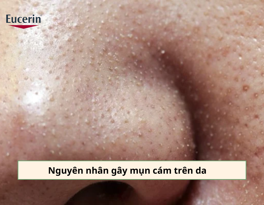 Nguyên nhân gây mụn cám trên da