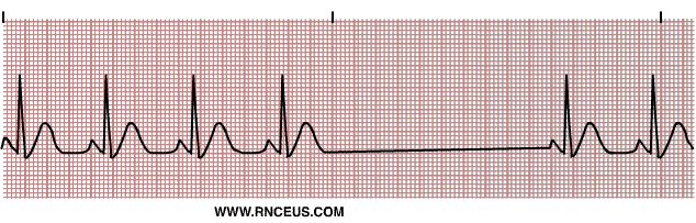 Sinus Arrest