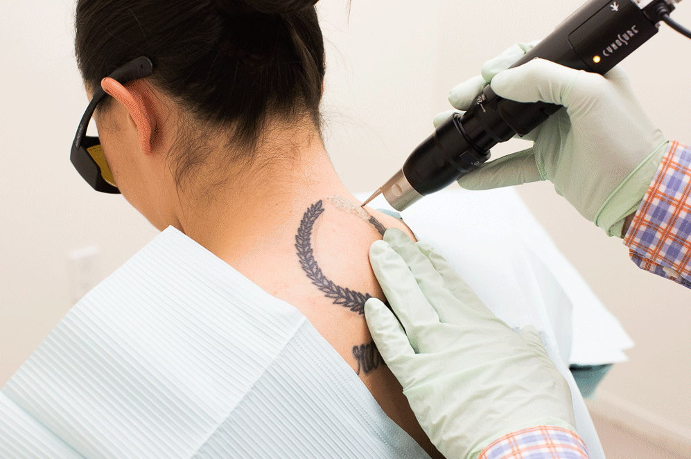 in this image the lady is getting the laser tatoo removal treatment at Renew you clinic. renewyou.co.in 