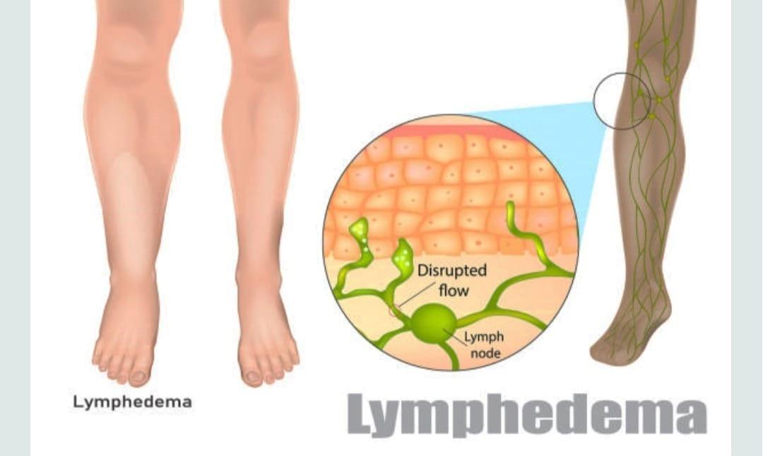 A diagram of lymph nodes

AI-generated content may be incorrect.