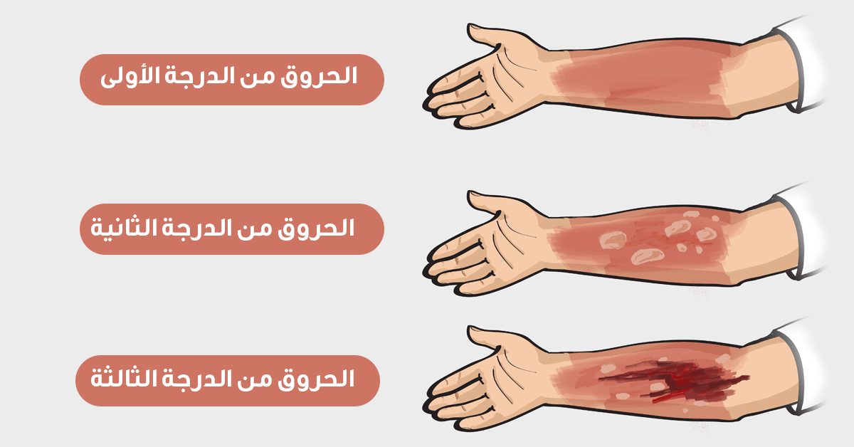 درجات الحروق ونصائح لعلاجها - ويب طب