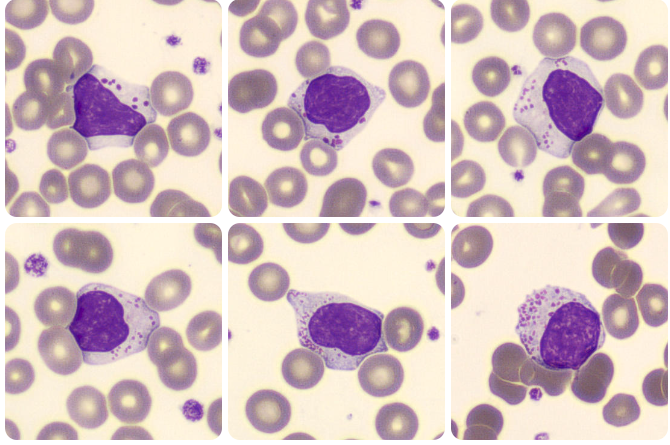  leucemia de grandes linfócitos granulares