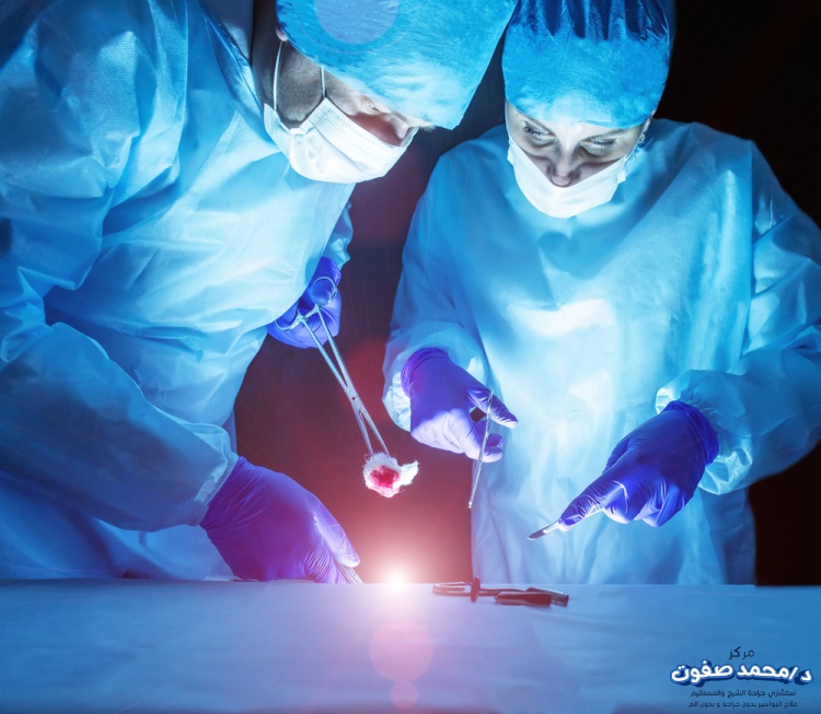 عملية البواسير بالليزر.