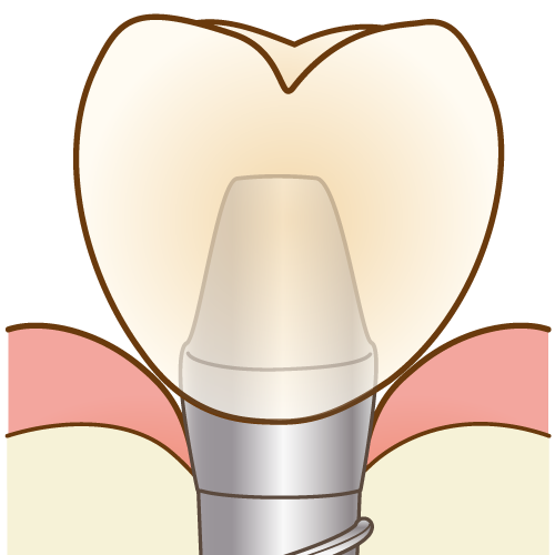 https://www.dental-sozai.com/illust/i/implant-compare007.png