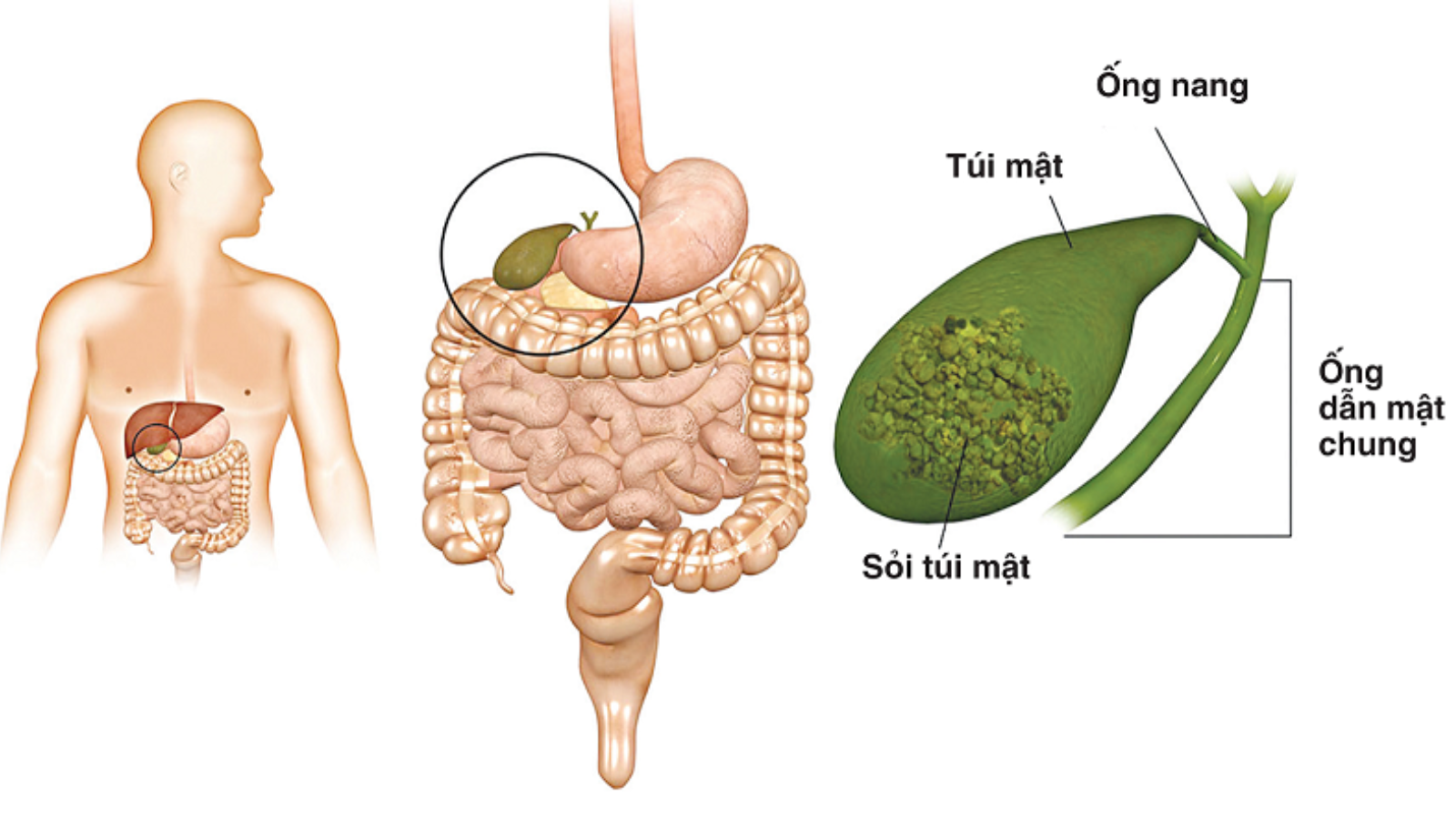 bien-chung-sau-mo-cat-tui-mat-nhung-dieu-ban-can-biet-de-bao-ve-suc-khoe 2