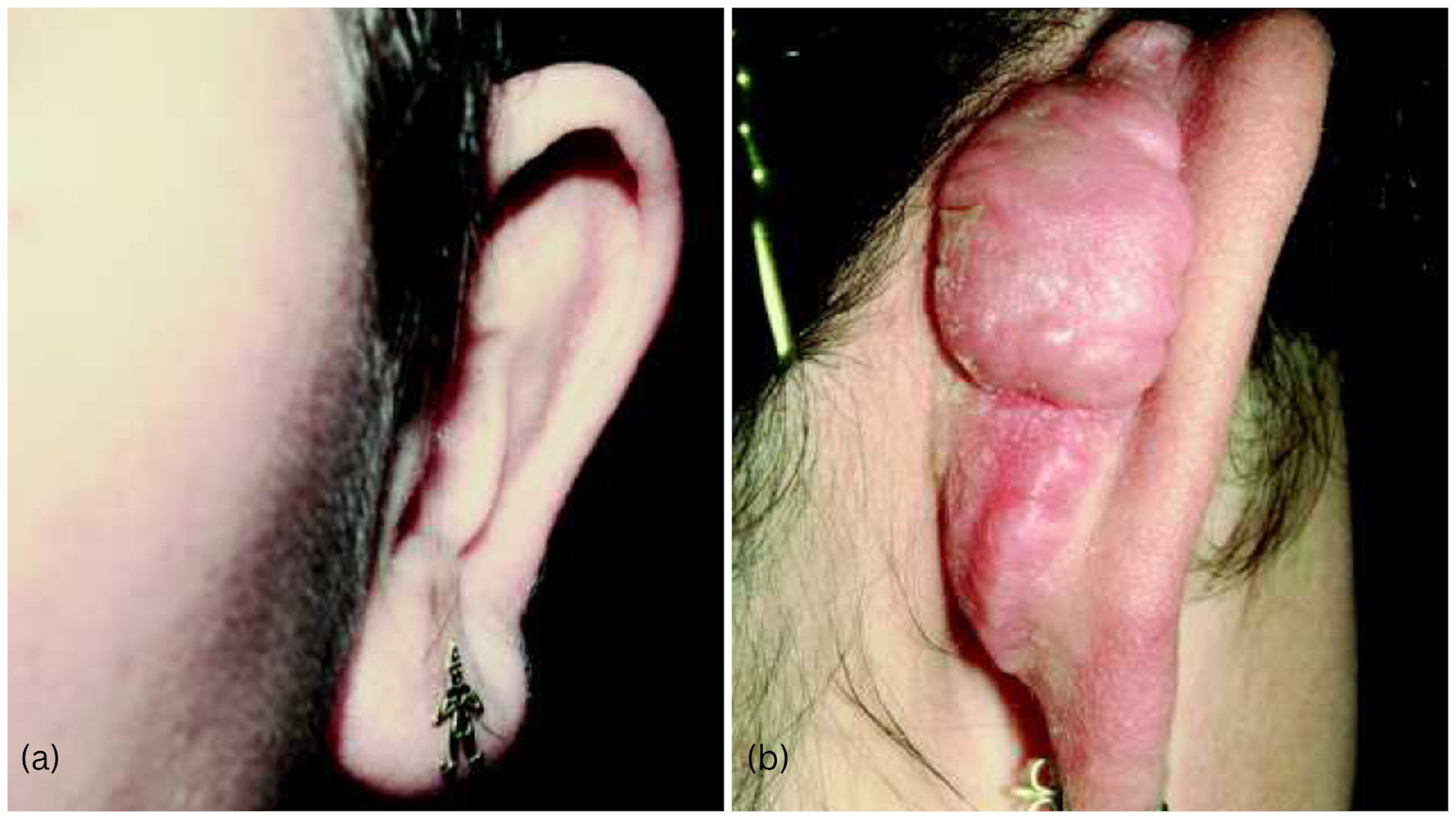 Otoplasty gone wrong- Showing keloid formation and telephone deformity