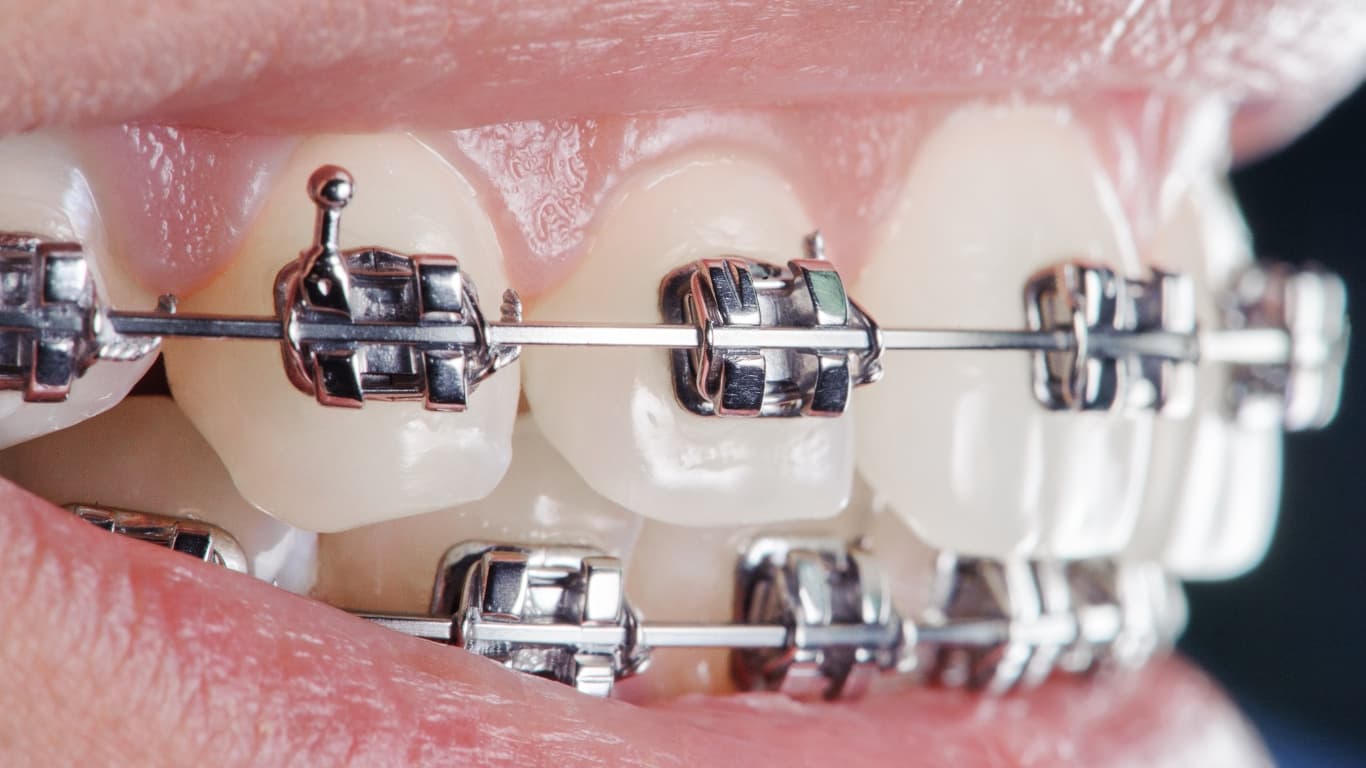 Metal Braces (Traditional Braces)