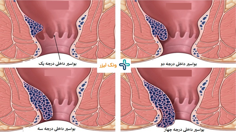 درجات هموروئید داخلی