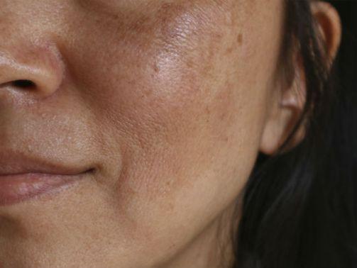 Qué es el melasma facial y cómo combatirlo? - Bulevar Sur