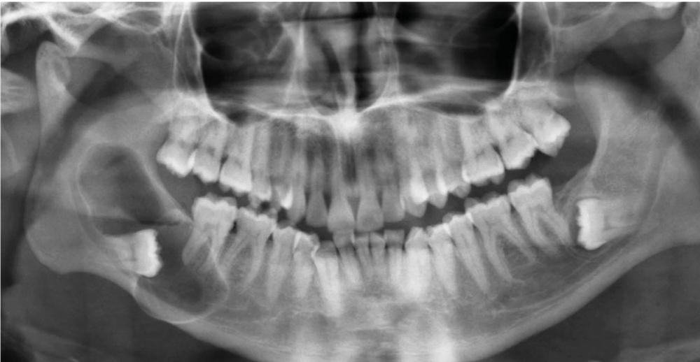 Prise en charge d'un kyste dentigère par décompression – L'Information  Dentaire