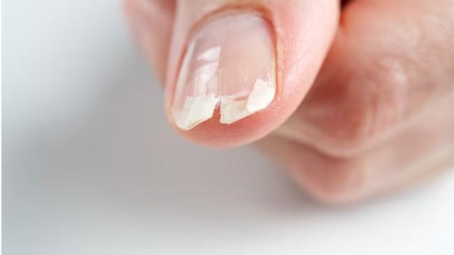 Unhas Fracas e Quebradiças: Causas e Soluções para Unhas Saudáveis