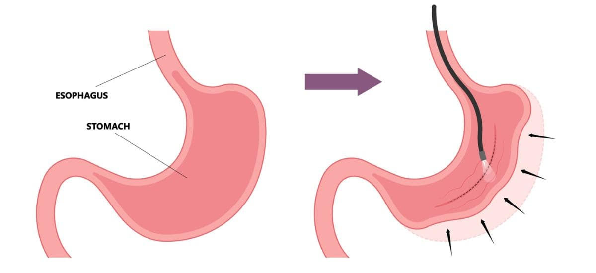 Endoscopic Sleeve Gastroplasty