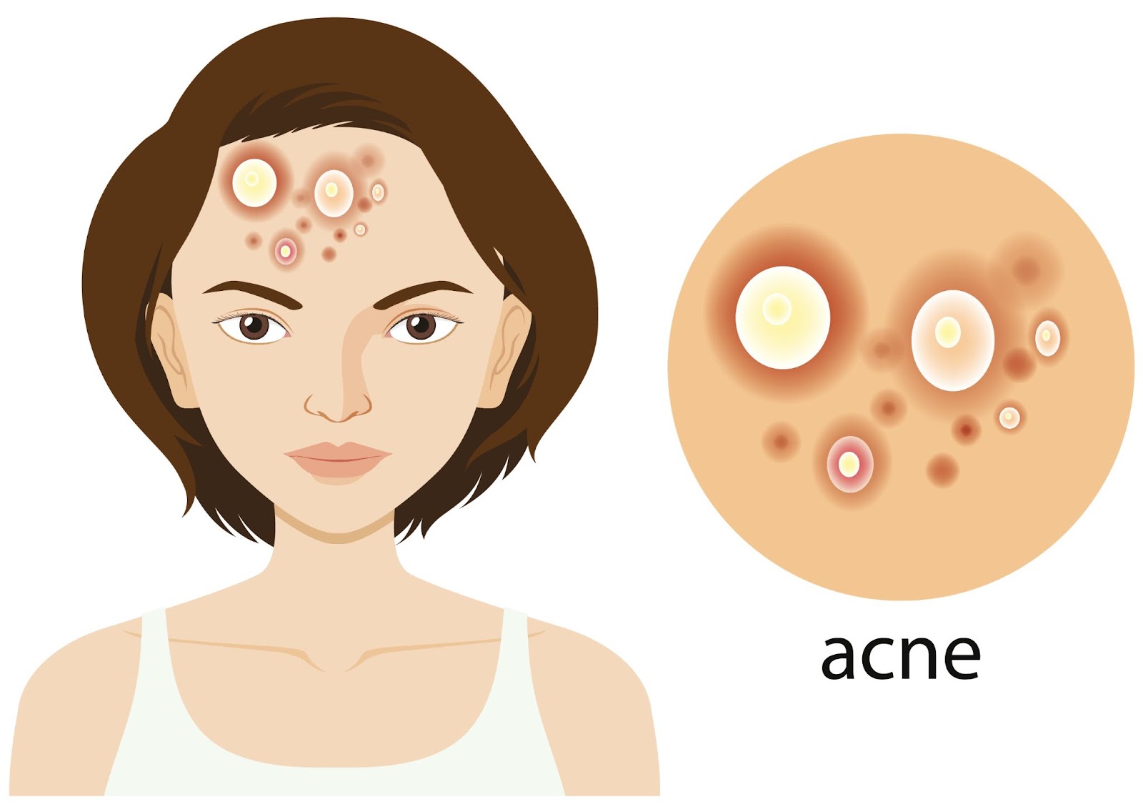 Acne-Prone Skin