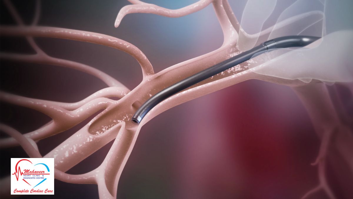Embolectomy by Dr Rakesh Jain - Heart Specialist In Indore