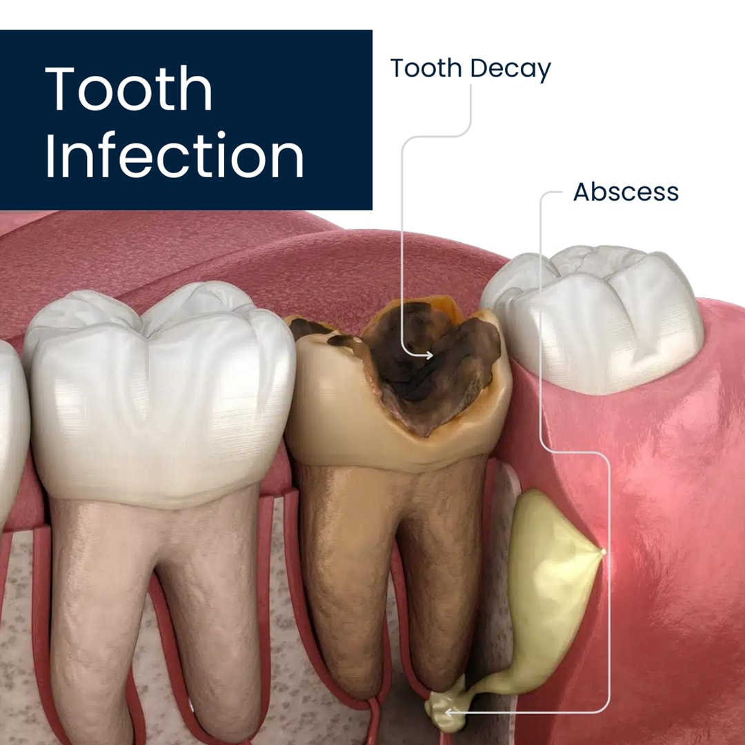 How to Tell If You Have Mild Tooth Infection: Early Detection Tips