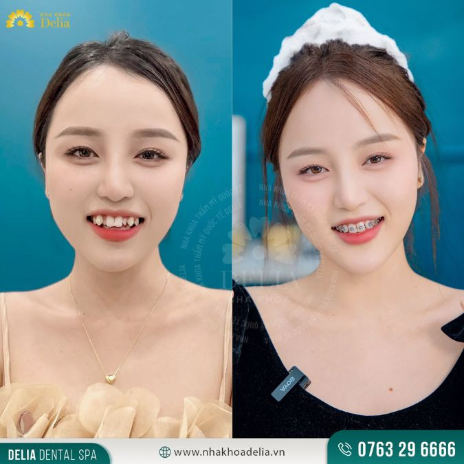Răng hô nên niềng hay bọc sứ? - Nha khoa Delia