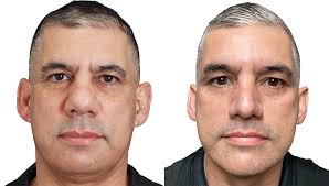a picture describe bulbous rhainoplasty
