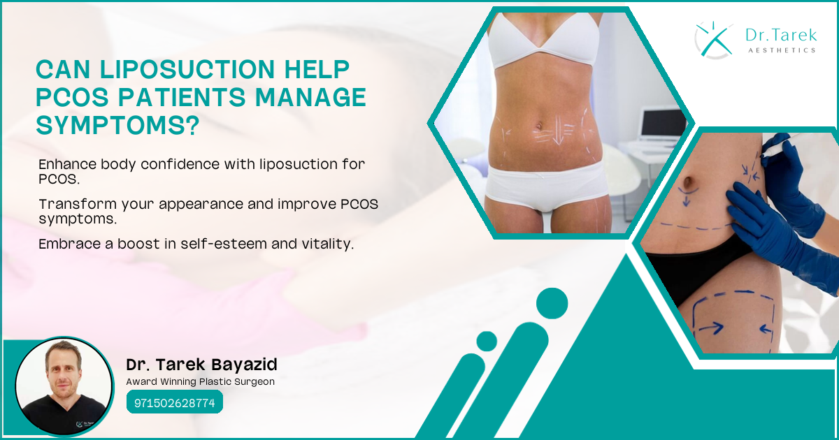 Can Liposuction Help Pcos