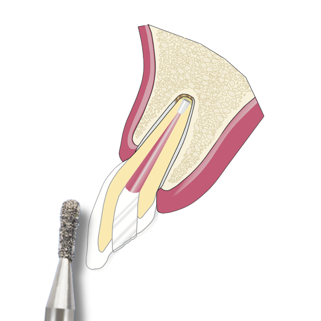 Mr. Bur Cosmetic Restorative 3-in-1 Kit FG includes burs for depth marking, reduction, margin creation, and finishing, ideal for veneers, crowns, inlays, and cosmetic restorations.