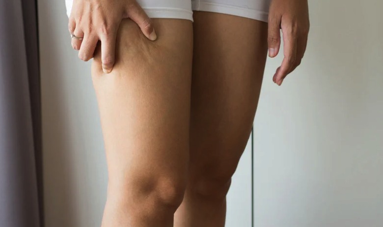 What is cellulite