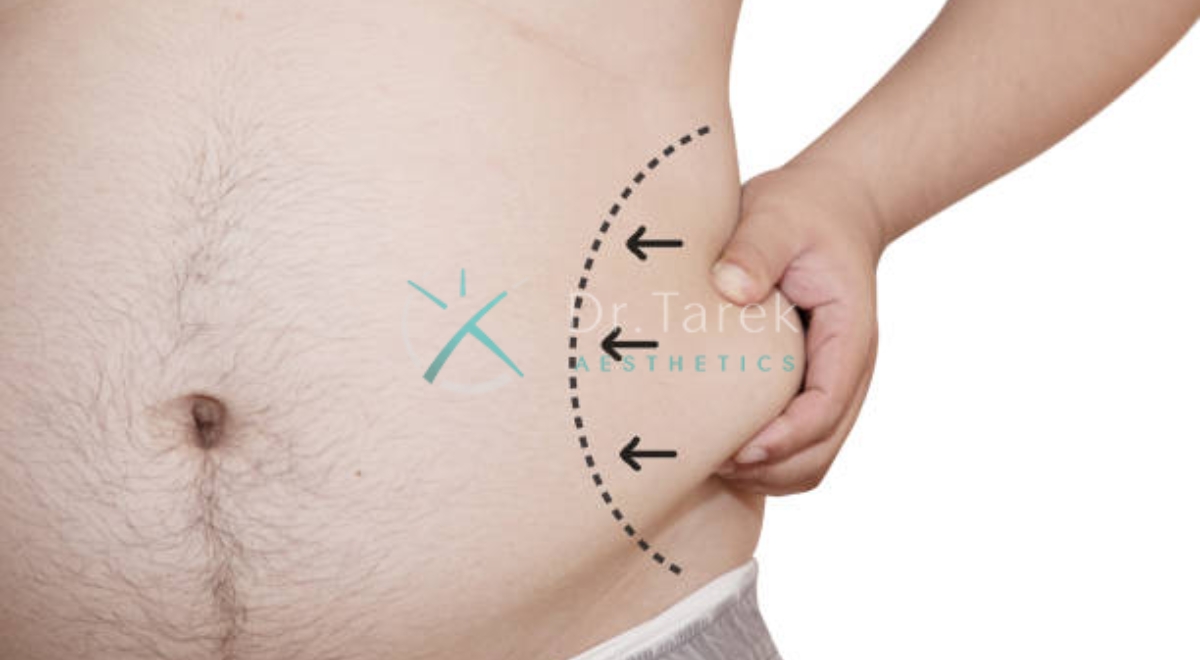 Where Is Lipo To Flanks 4 Dr. Tarek Aesthetics | Best Plastic Surgeon In Dubai Where Is Lipo To Flanks