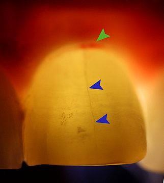 Résultat de recherche d'images pour "test de transillumination dentaire"