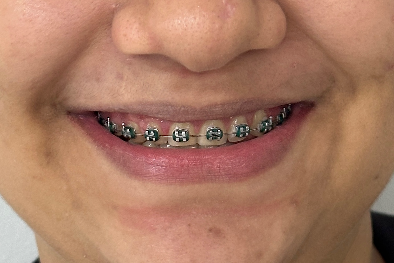 Rosto de homem de boca aberta mostrando os dentes

Descrição gerada automaticamente